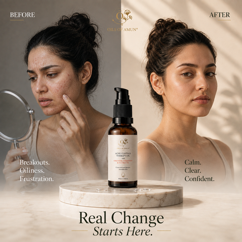 Acne Control Therapy Oil | Natural Face Serum for Acne-Prone Skin